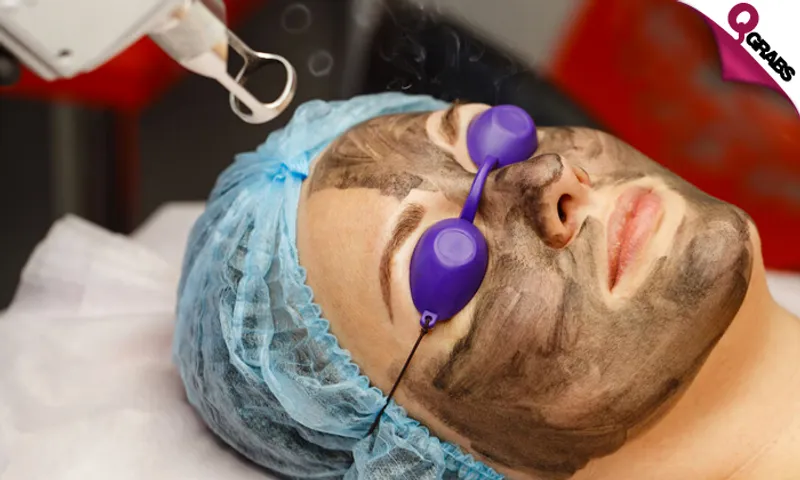 Carbon Laser Facial for Ladies & Men!